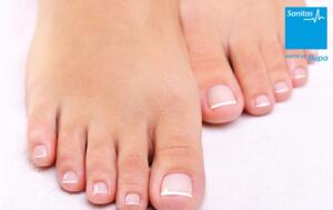 Descuento: 5 sesiones de láser para micosis