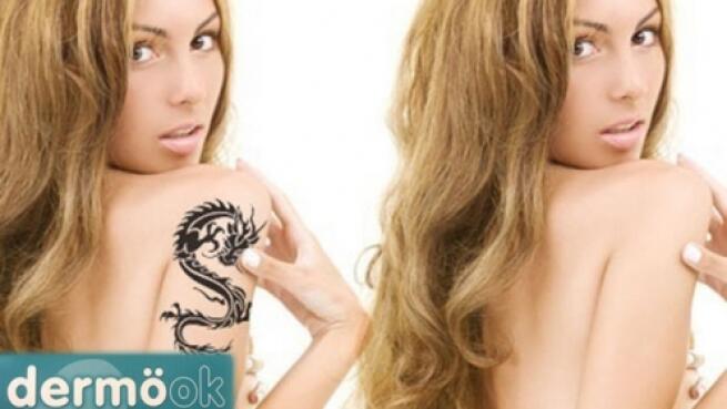 Sesiones eliminación de tatuajes en San Pedro por 45 € oferta